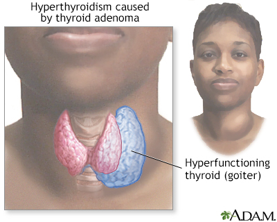 Goiter