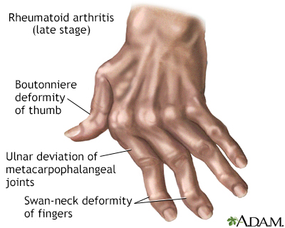 Rheumatoid arthritis