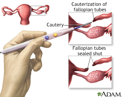 Tubal ligation