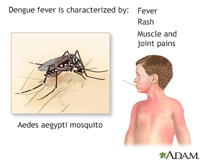 Dengue fever