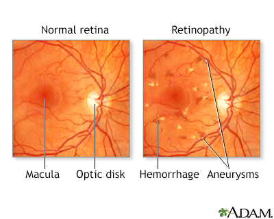 Diabetic retinopathy