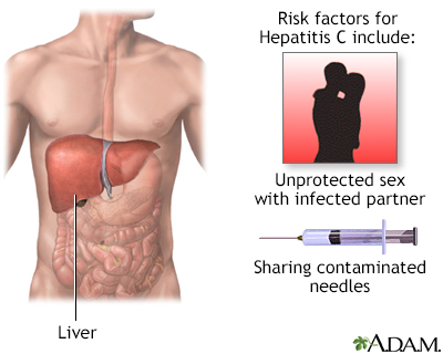 Hepatitis C