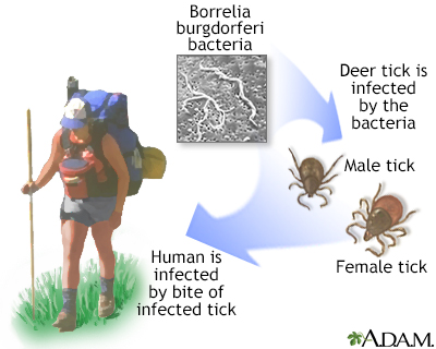 Lyme disease