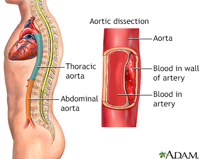 Aortic dissection