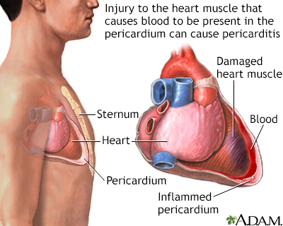 Post-MI pericarditis