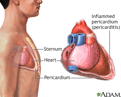 Pericarditis