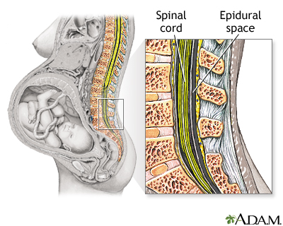 Epidural - series