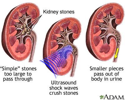 Lithotripsy procedure