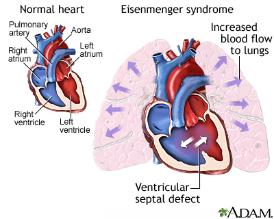 Eisenmenger syndrome (or complex)