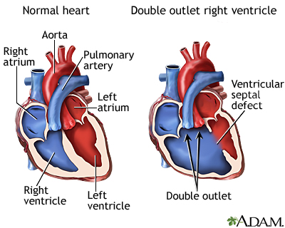 Doble salida ventricular derecha