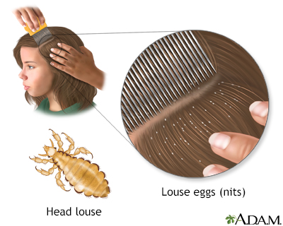 Head lice