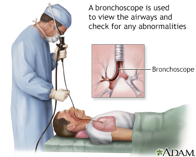 Bronchoscopy