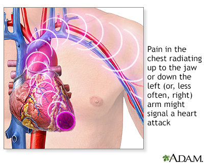 Heart attack symptoms